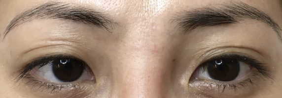 Eyeliner-Client-2-Before-